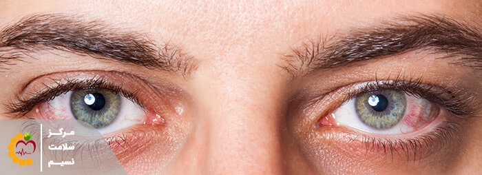خشکی چشم در افراد مانع از عمل لیزیک چشم میشود
