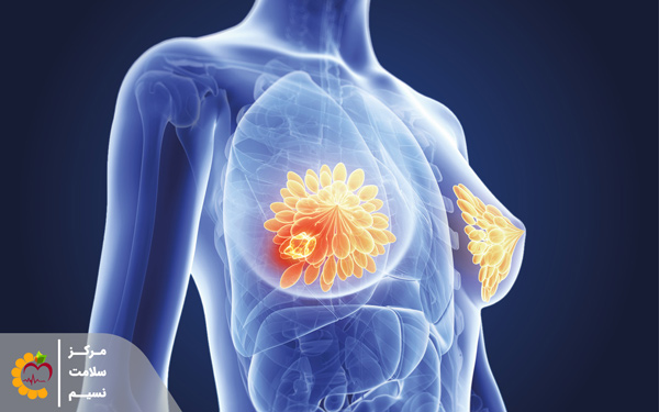 از نشانه های سرطان سینه وجود توده در سینه است، در تشخیص سرطان سینه با مامو گرافی توده و نشانه های دیگر مشخص میشود