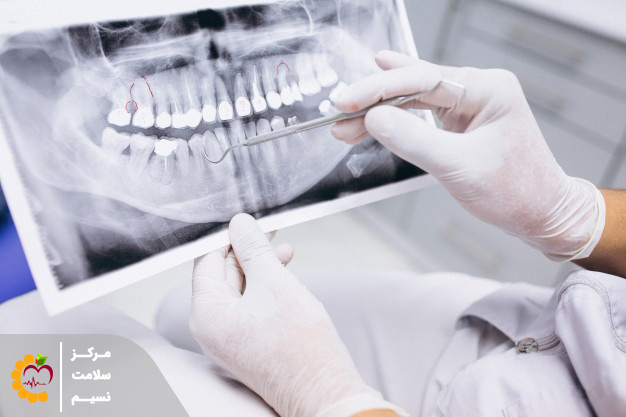 در عکس opg دندان چه مواردی تشخیص داده میشود؟