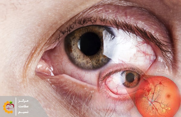 تأثیر دیابت بر چشم | دیابت با چشم‌ها چه‌ کار می‌کند؟