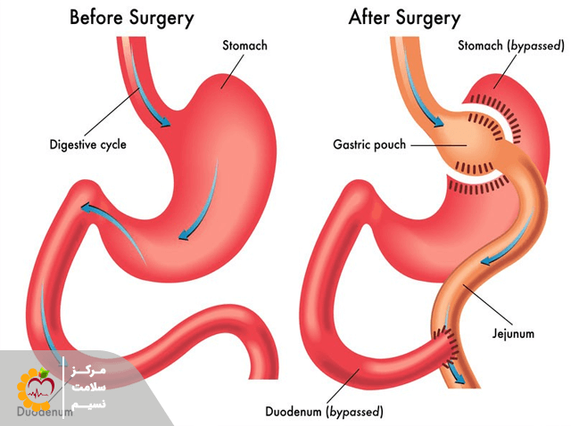 عمل جراحی چاقی  RYGB