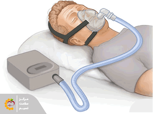 دستگاهی به نام فشار مثبت مداوم راه هوایی ( CPAP ):