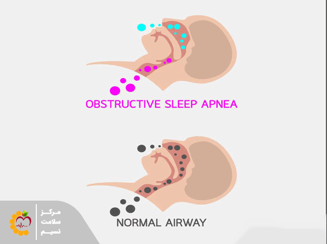 انواع آپنه خواب
