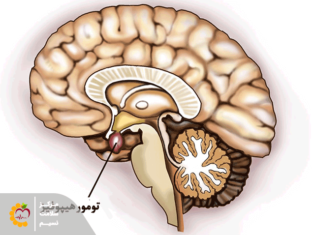 پرولاکتینوما در مغز 