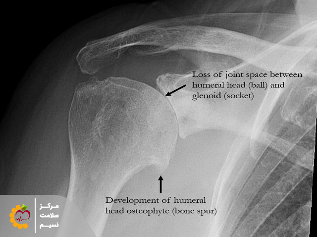 عکس x-ray از شانه مبتلا به آرتوز شانه 