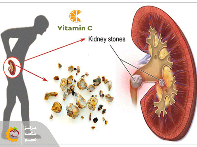 عوارض ویتامین سی بر کلیه