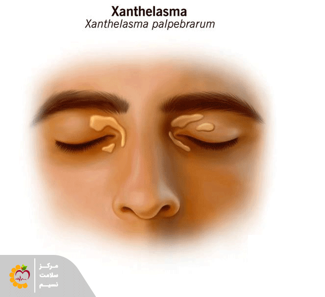 ضایعات زانتلاسما (Xanthelasma) چیست؟