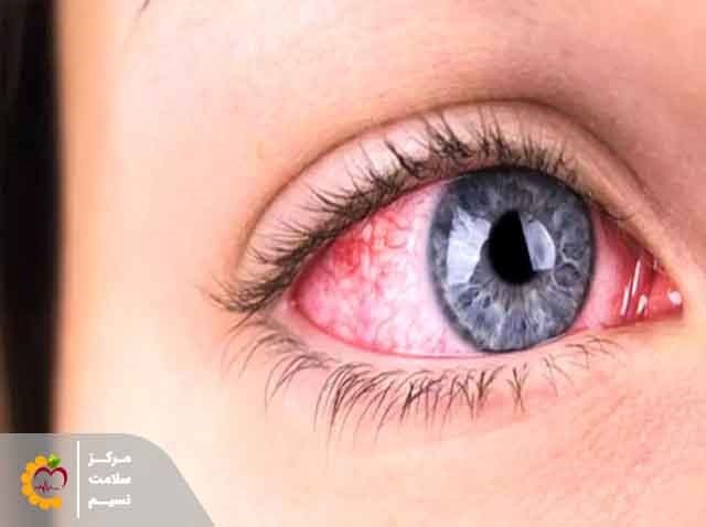 عفونت چشمی با لنزهای تماسی