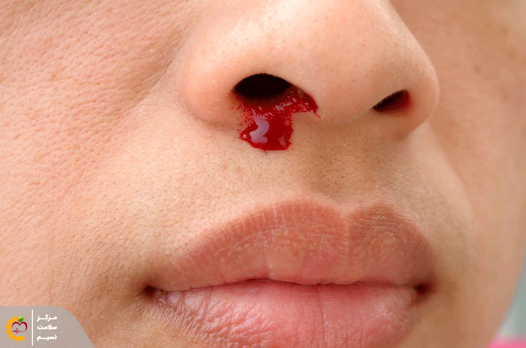 علت خونریزی بینی(اپیستاکسی)