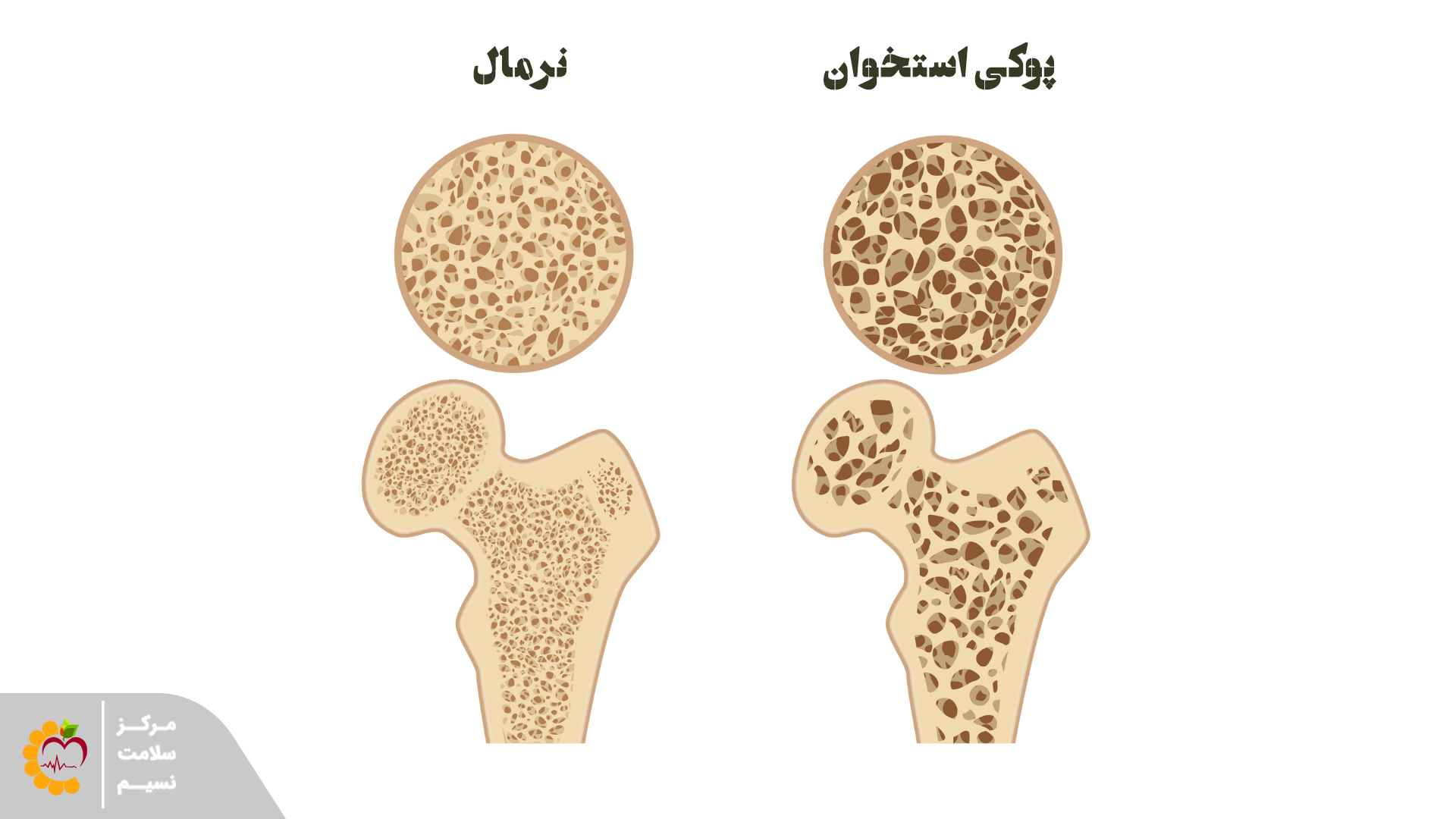 علائم مخفی پوکی استخوان