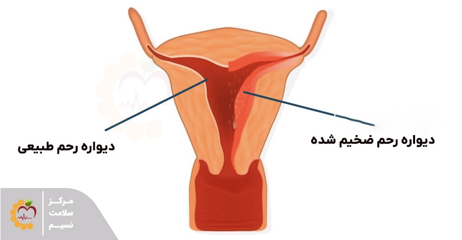 علت ضخامت دیواره رحم چیست؟ اهمیت چکاپ رحم و تخمدان